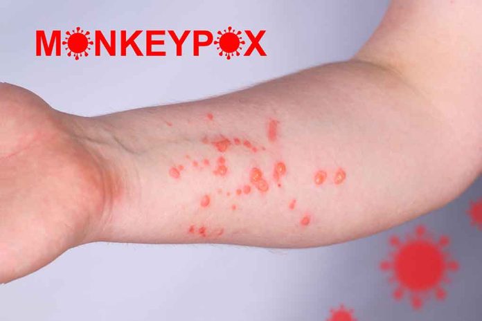 Monkeypox Declared a 