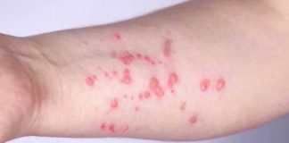 Boston Ties Mpox Vaccine Drive to Pride Month Opening Boston residents encouraged to get mpox vaccine amid uptick in cases